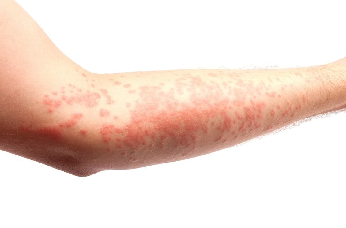 bilastine for Urticaria - Australia's latest antihistamine in more than a decade.